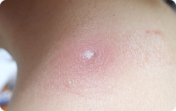 粉瘤・できものの日帰り切除手術に対応