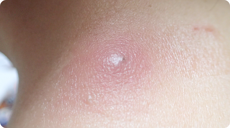 粉瘤・できものの日帰り切除手術に対応